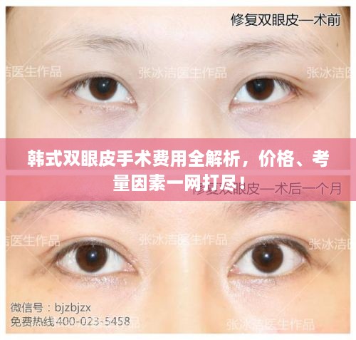 韓式雙眼皮手術(shù)費用全解析，價格、考量因素一網(wǎng)打盡！