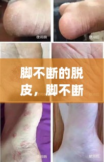 腳不斷的脫皮，腳不斷脫皮還癢 