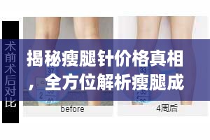 揭秘瘦腿針價(jià)格真相，全方位解析瘦腿成本！