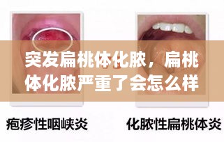突發(fā)扁桃體化膿，扁桃體化膿嚴(yán)重了會怎么樣了 