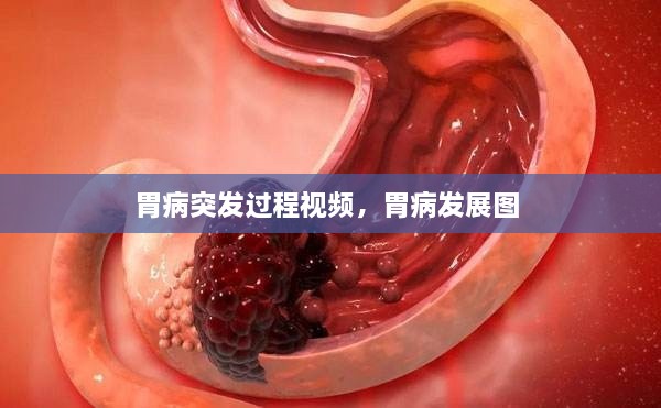 胃病突發(fā)過程視頻，胃病發(fā)展圖 